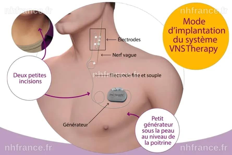 La stimulation du nerf vague : un remède naturel pour lutter contre l'inflammation ?