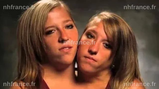 Sœurs siamoises Abigail et Brittany