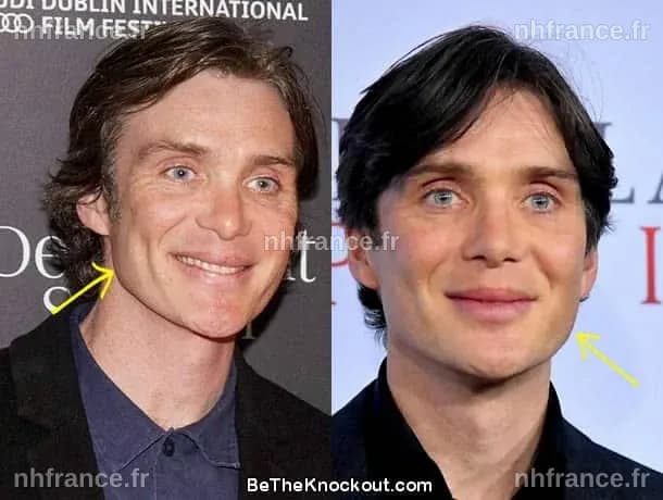 Cillian Murphy avant et après chirurgie